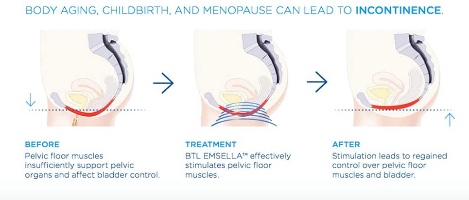 Body Aging, Childbirth and Menopause can lead to Incontinence