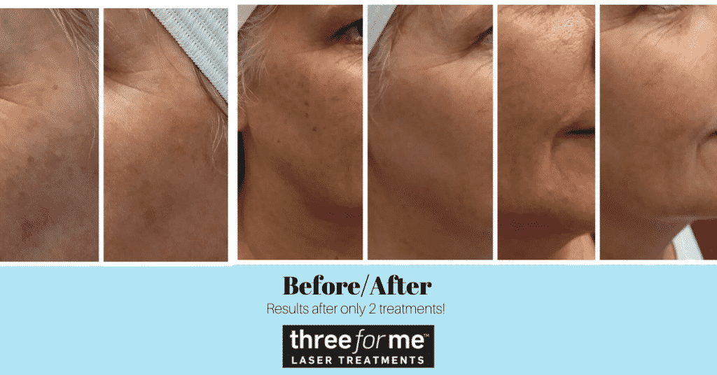 Before and After Laser Treatments