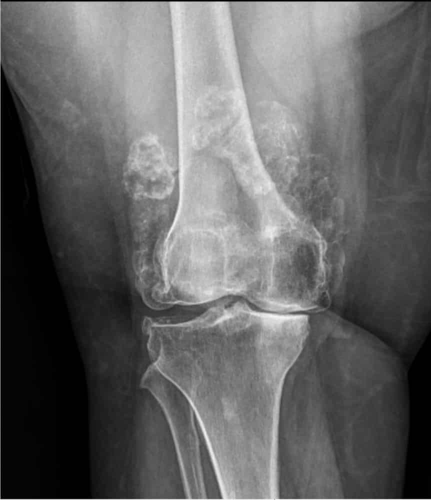 Osteoporosis - Xray