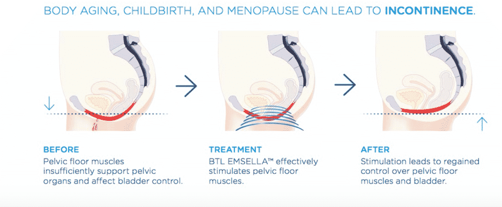 Body Aging and Childbirth can lead to incontinence