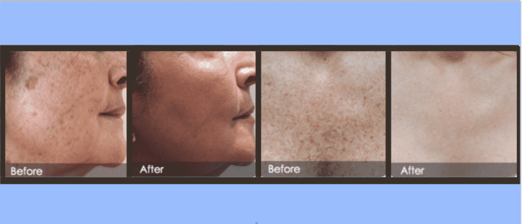 Before and After IPL Photofacial