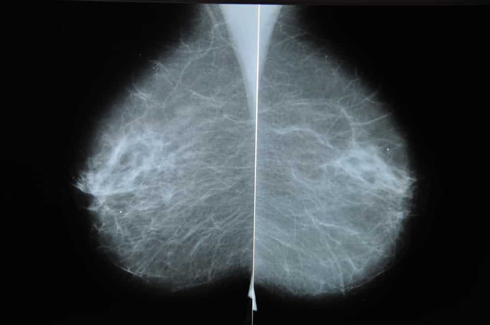 Expanded Coverage for Diagnostic Mammograms