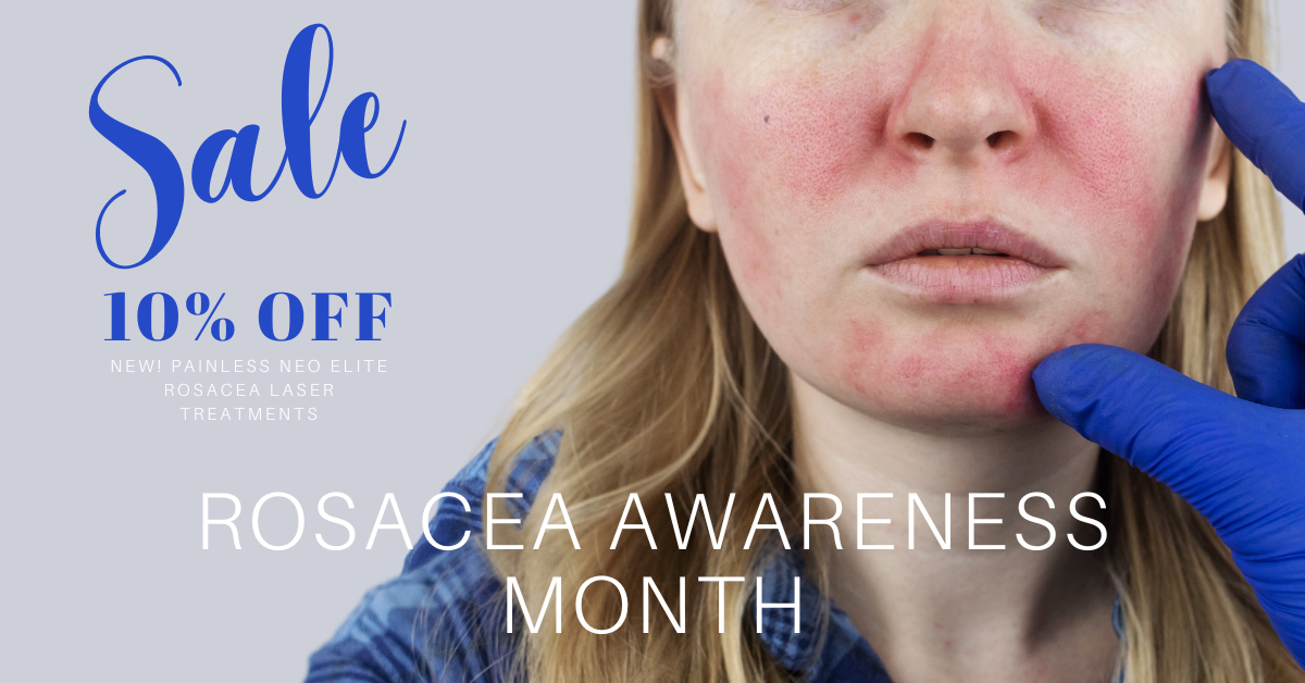 1200X628 ROSACEA AWARENESS SALE NEO APRIL2023 2024 woman face with rosacea.